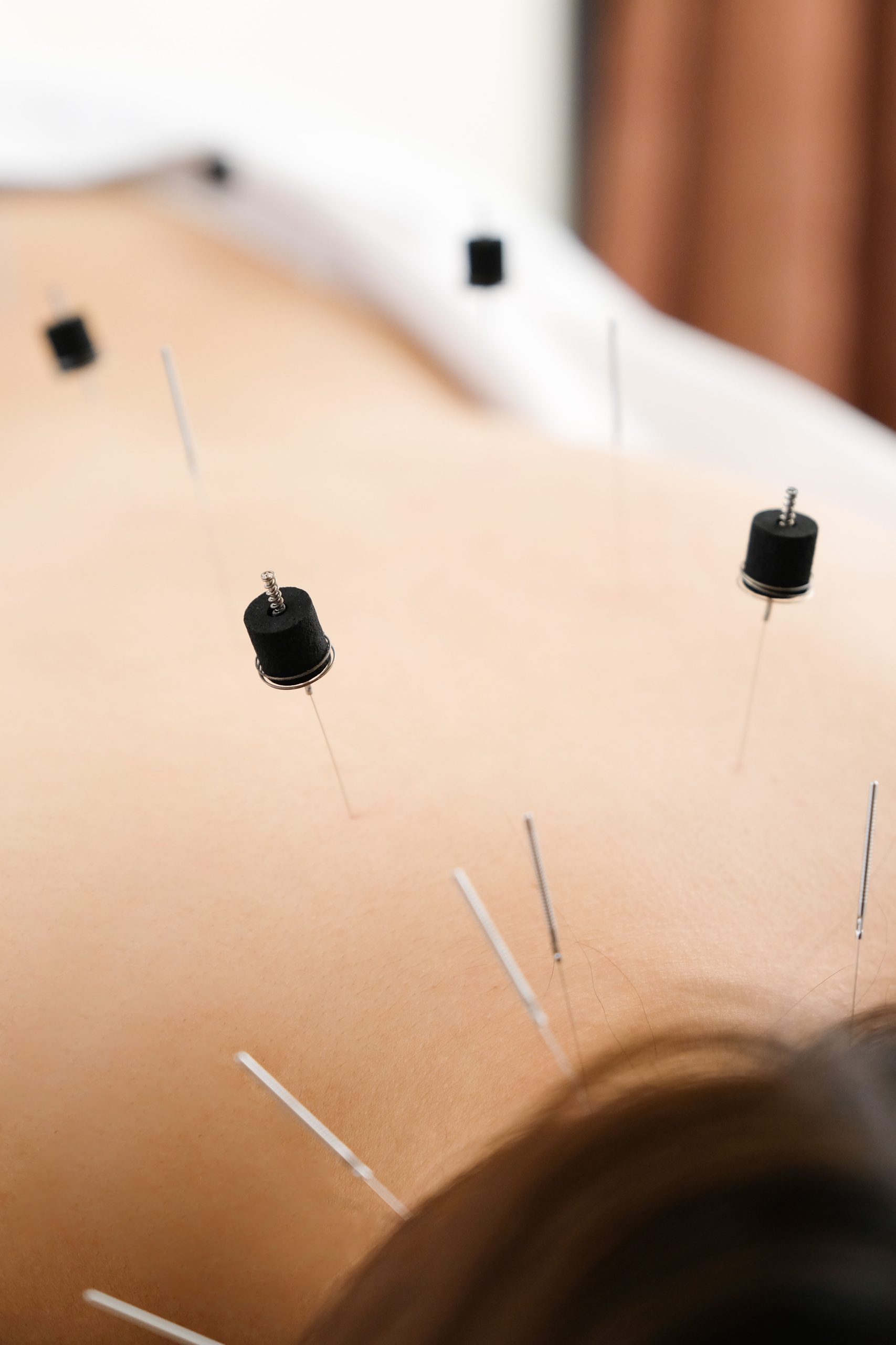 A woman with a needle stuck to her back at a bright acupuncture clinic